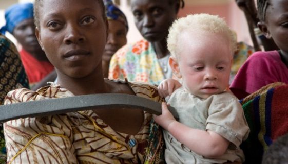 Mãe com criança albina - Foto: ONU/Marie Frechon