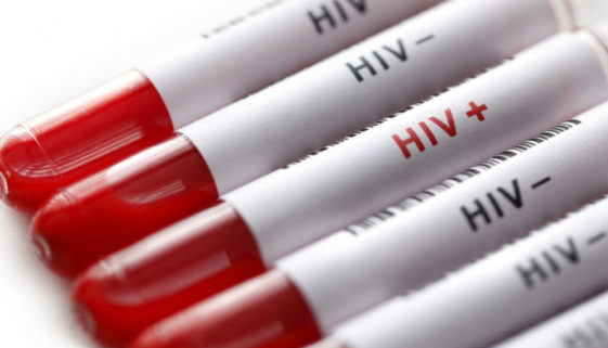 36,9 milhões de pessoas no mundo vivem com o vírus HIV