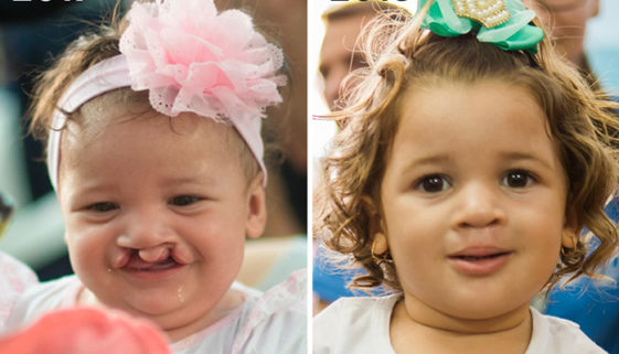 Operação Sorriso promove campanha para o Dia da Criança