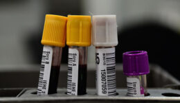Brasil é um dos países que menos realiza testes para Covid-19