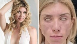 Após problemas com cirurgia plástica, miss fica sem sorrir e piscar
