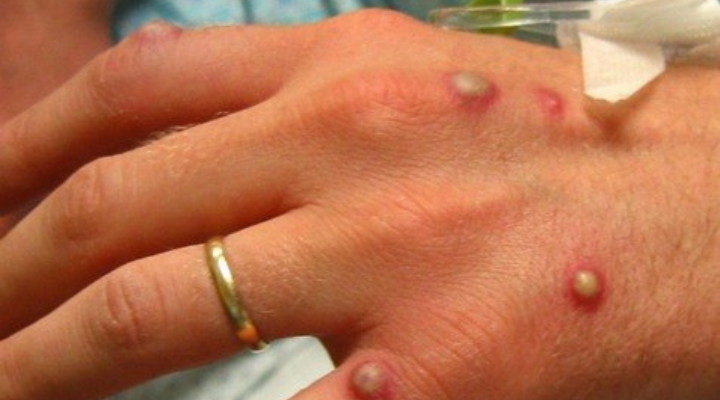 Perigo ignorado: Brasil tem mais de 200 casos de varíola do macaco