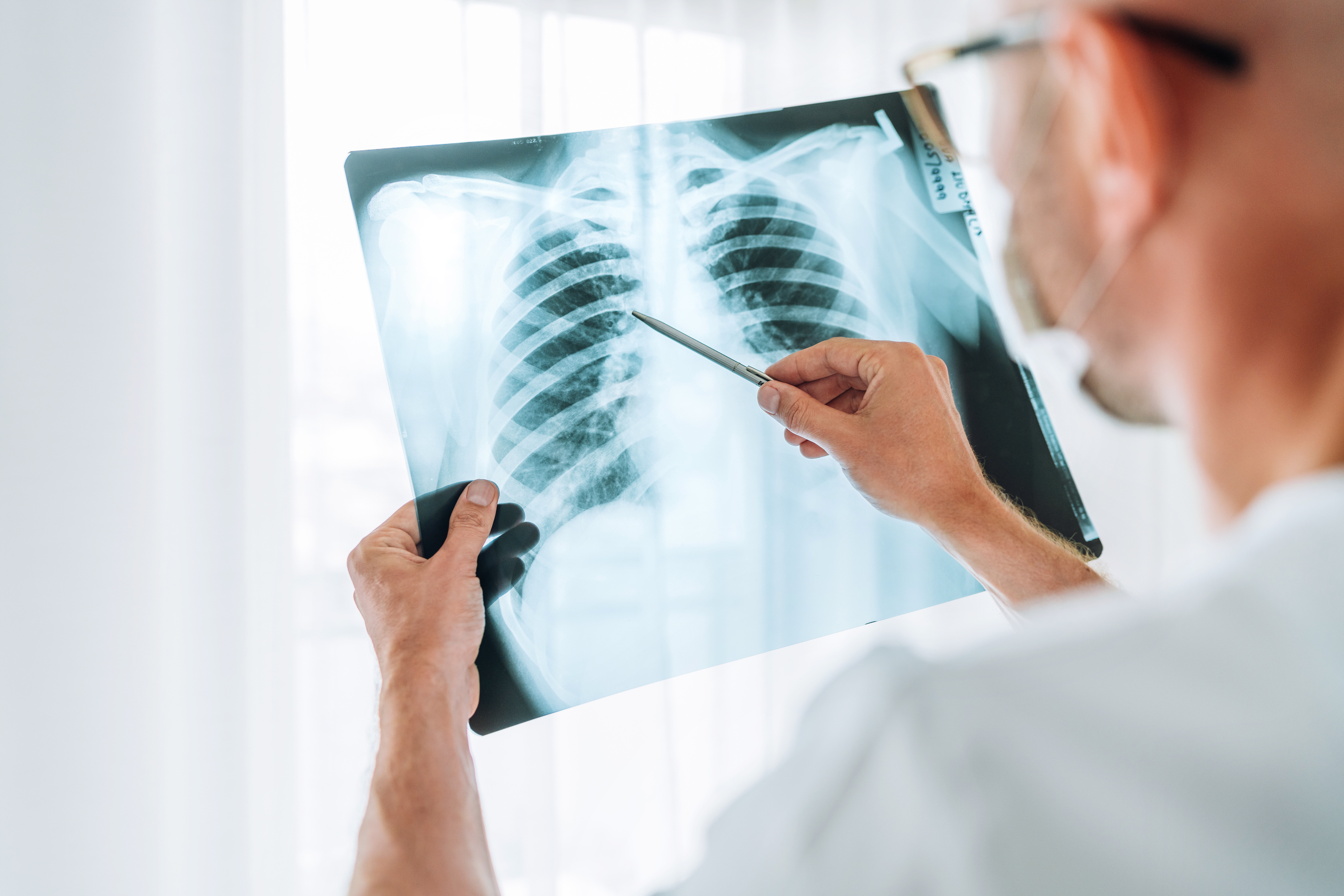 Perigo: Brasil registrou 78 mil casos de tuberculose em 2022