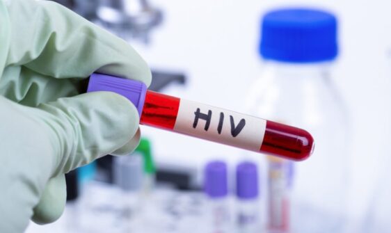 HIV