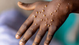 Europa registra 100 casos diários de Mpox e OMS pede ação internacional