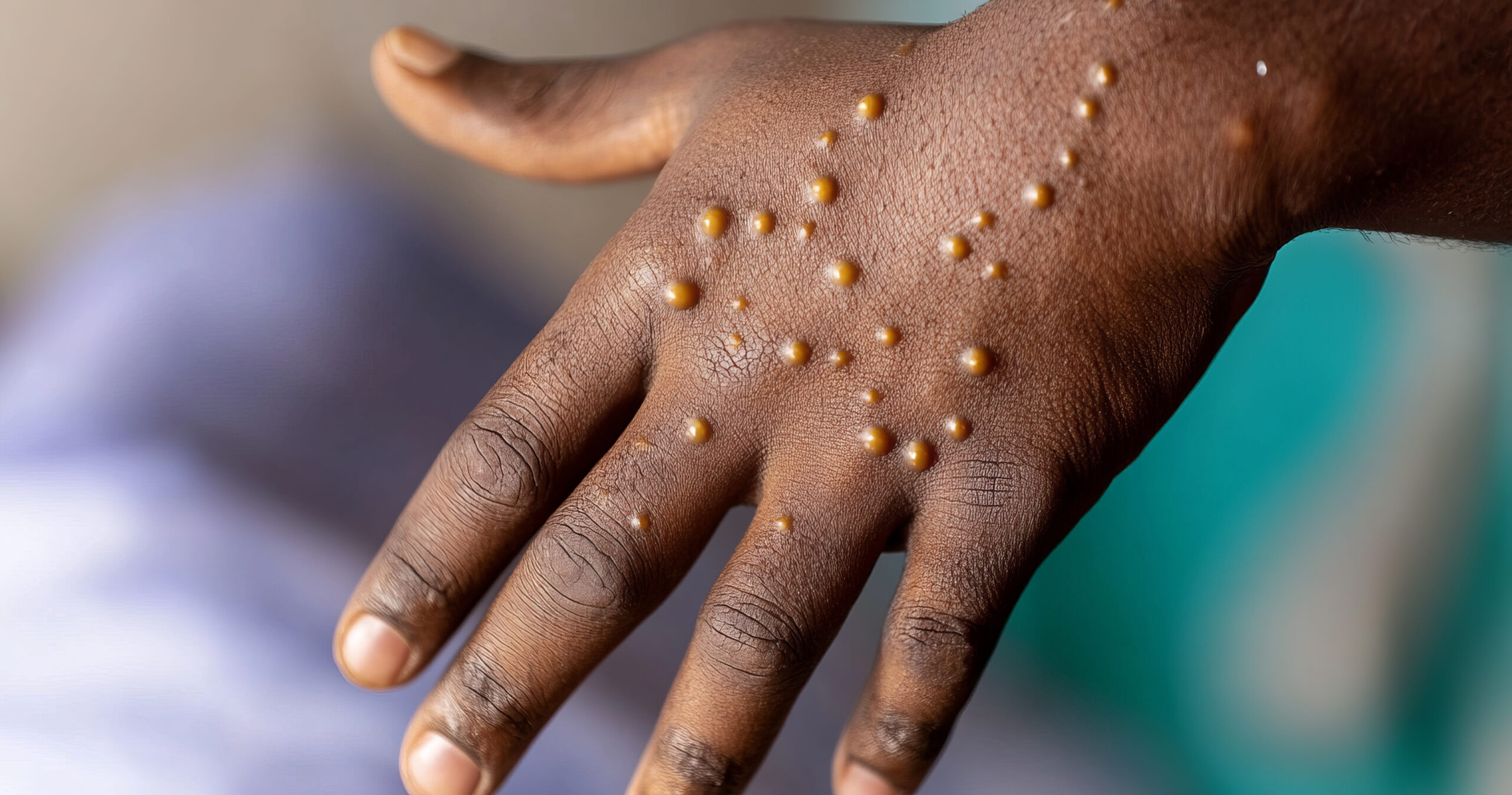 Europa registra 100 casos diários de Mpox e OMS pede ação internacional
